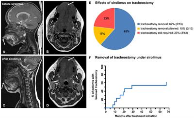 Efficacy of Sirolimus in Patients Requiring Tracheostomy for Life-Threatening Lymphatic Malformation of the Head and Neck: A Report From the European Reference Network